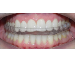 teeth whitening in calgary | free-classifieds-canada.com - 1