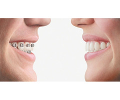 Get 6-month smile Braces at Plessis Dental | free-classifieds-canada.com - 1