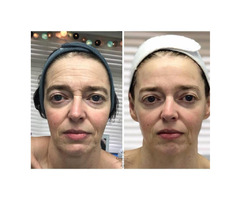 Holistic Non-Surgical Face Lift / Advanced Facial Skin Corrective Therapy | free-classifieds-canada.com - 8