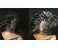PRP hair treatment in Calgary | free-classifieds-canada.com - 1