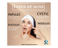 Laser acne treatment clinic in Alberta | Oxyderm Laser Clinic | free-classifieds-canada.com - 1
