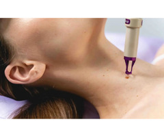 Safe and Effective Mole Removal Services | free-classifieds-canada.com - 1