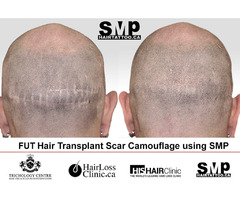 Are You Searching For Scalp Micropigmentation cost In Toronto? | free-classifieds-canada.com - 2