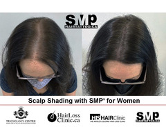 Are You Searching For Scalp Micropigmentation cost In Toronto? | free-classifieds-canada.com - 3