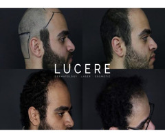 PRP for Hair Loss  | free-classifieds-canada.com - 1