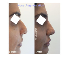 Get Non-Surgical Nose Augmentation in Richmond | free-classifieds-canada.com - 1