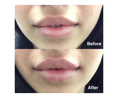 Choose Top Non-Surgical Lip Augmentation in Richmond | free-classifieds-canada.com - 1
